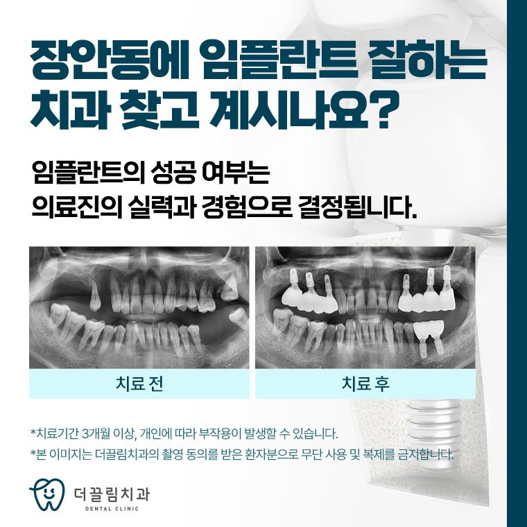 장안동임플란트 왜 ‘치료 케이스’를 확인해야 할까? 썸네일