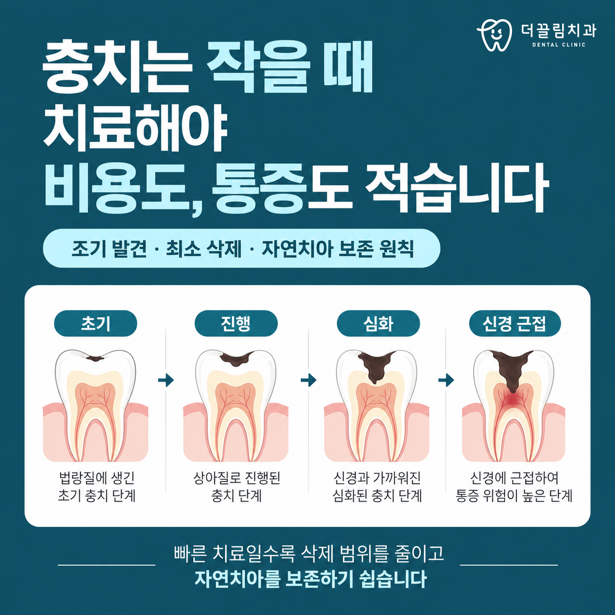 충치 1,2,3단계 치료방법 더끌림치과의원