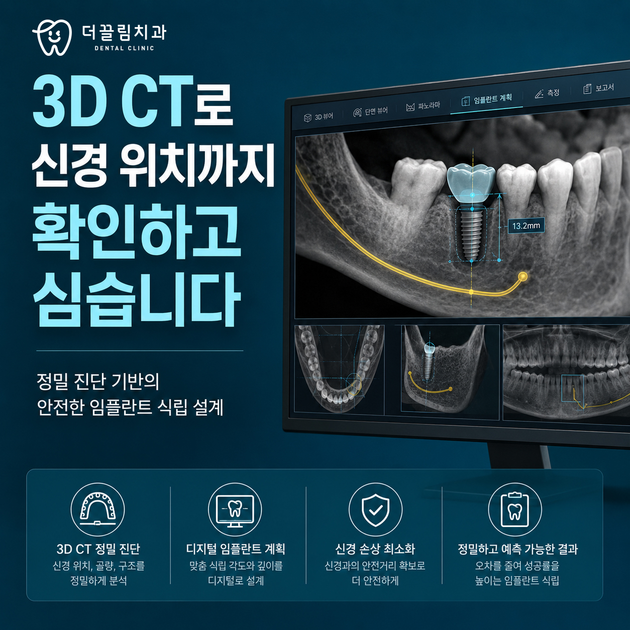 임플란트 치료, 3차원 정민 진단 선행